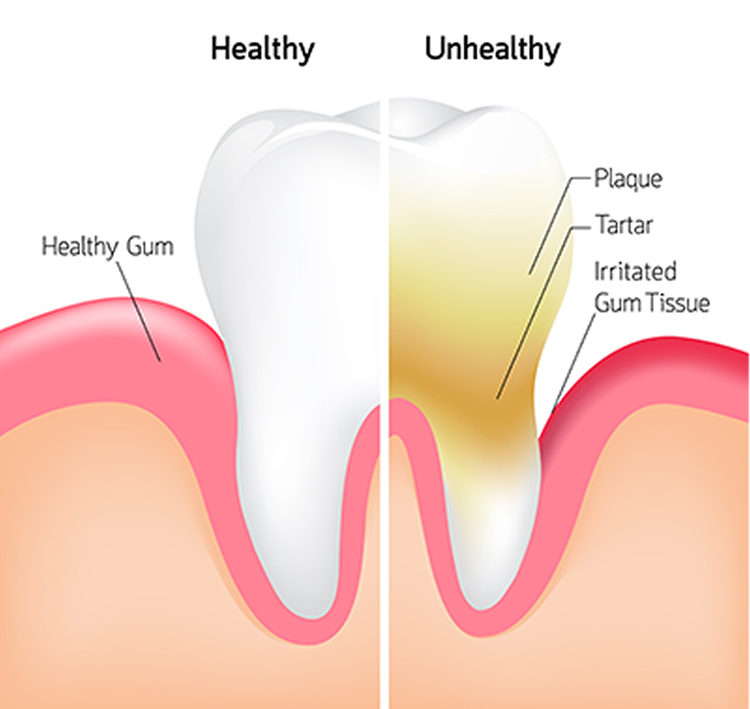 Differentiating Between Plaque and Tartar