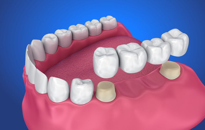 3D rendering of a traditional dental bridge attached with a crown