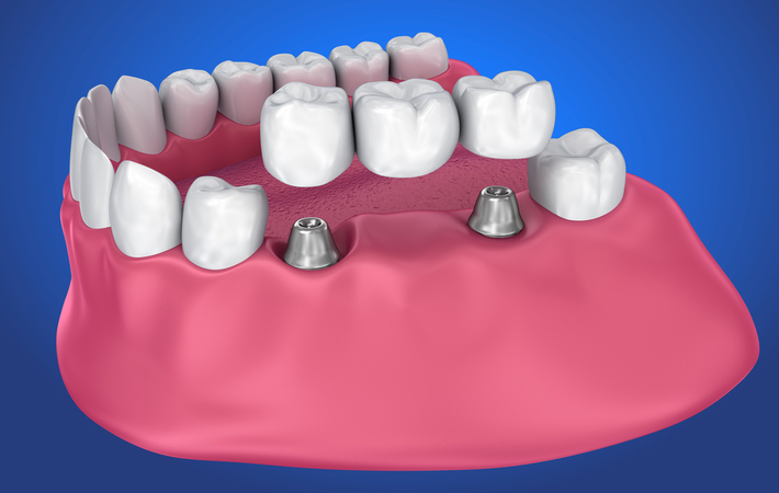 3d rendering of an implant dental bridge