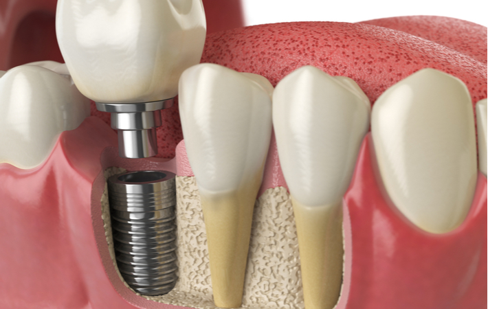 a 3D rendering of a dental implant below the gum line