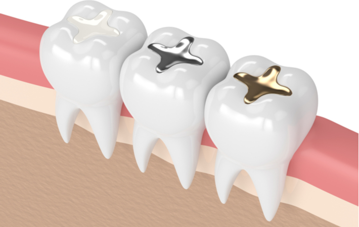 3d rendering dental filling types composite silver and gold