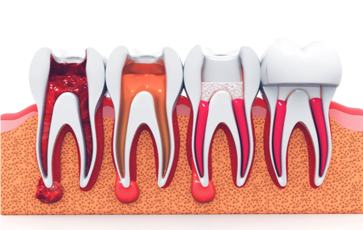 3d rendering of a tooth before and after rool canal treatment