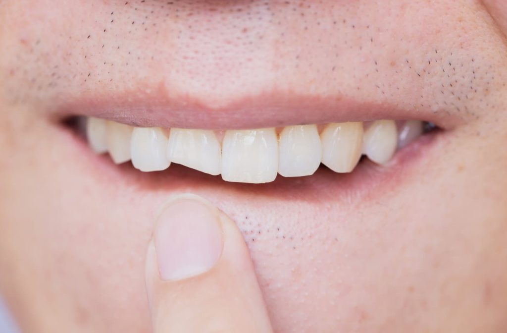 Person pointing at their broken tooth with the index finger