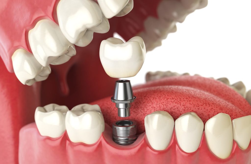 3D rendering of a dental crown being place on the abutment of a dental implant