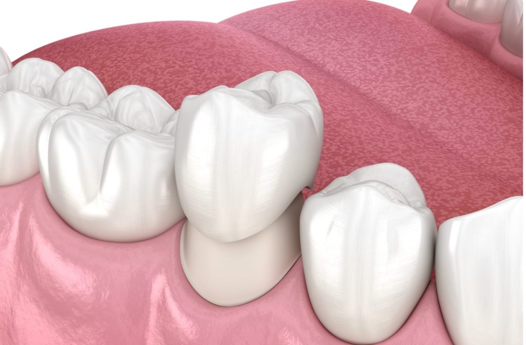 3D illustration of a dental crown being placed on a premolar