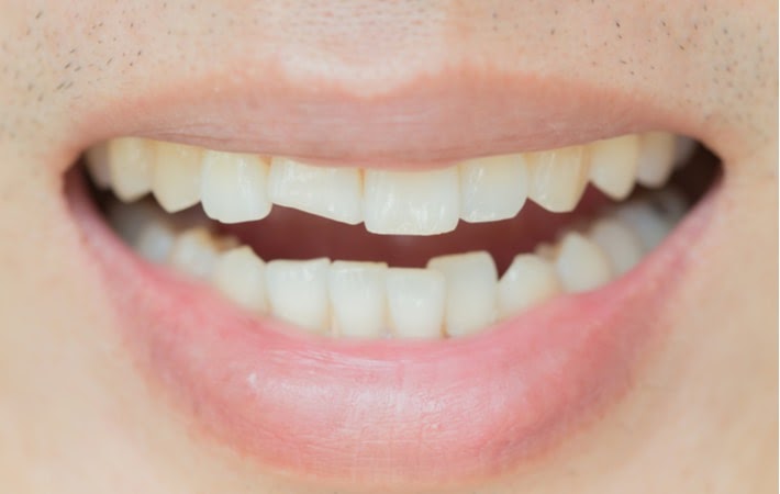Close up of a person with a  chipped/broken tooth needing treatment