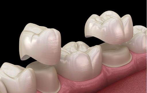 A 3D illustration of two porcelain dental crowns being placed