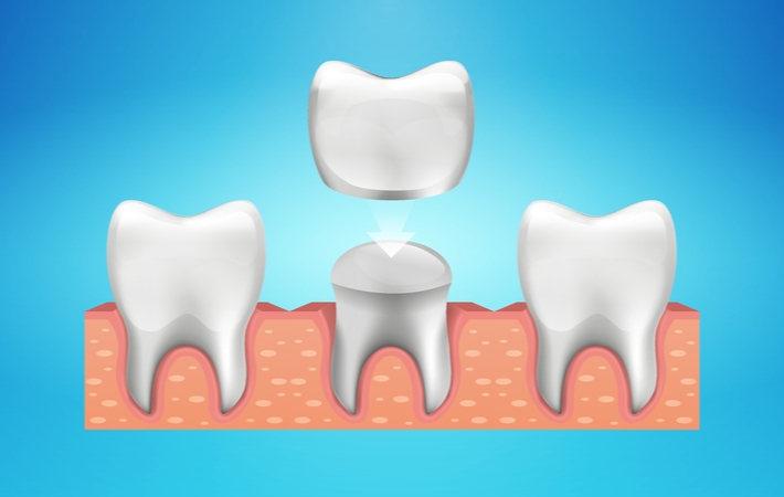 A illustration of a dental crown being placed between two other teeth