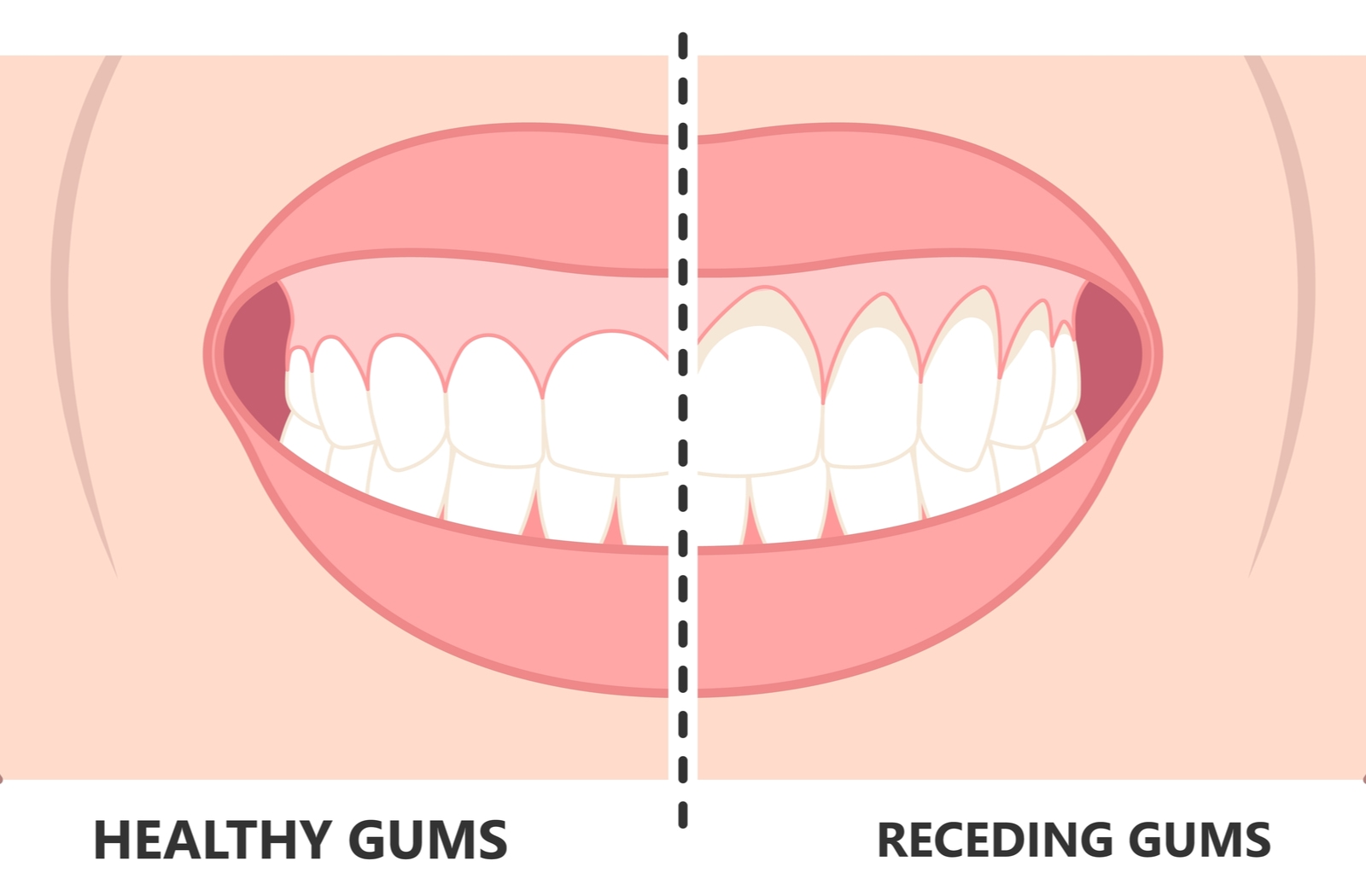 How To Stop Receding Gums From Getting Worse Calgary