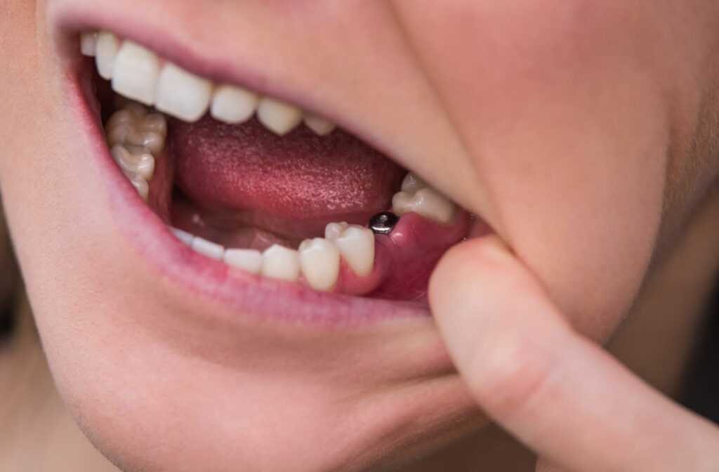 Close-up view of a single tooth implant in the lower jaw of a young woman's missing tooth.