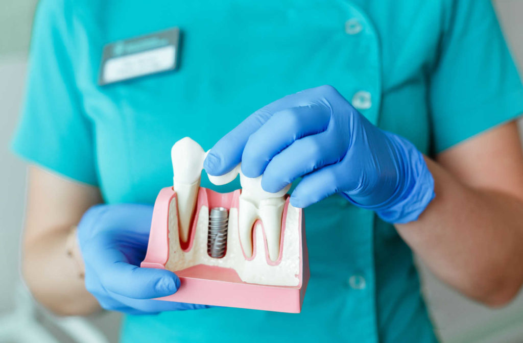 Hands of a dentist holding a model of a  tooth with an implant.