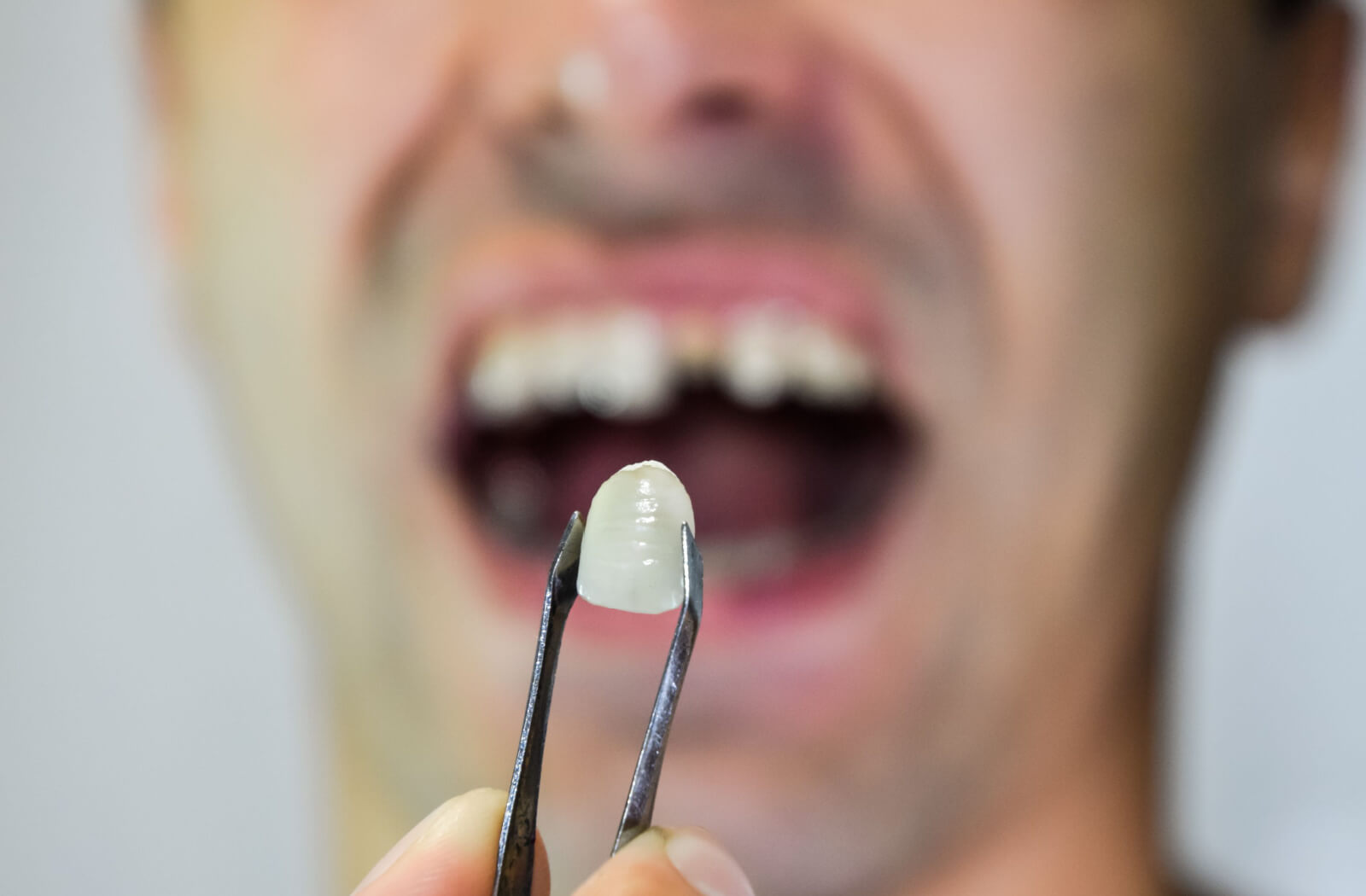 An up-close view of a dental crown intended for installation on a man's tooth.