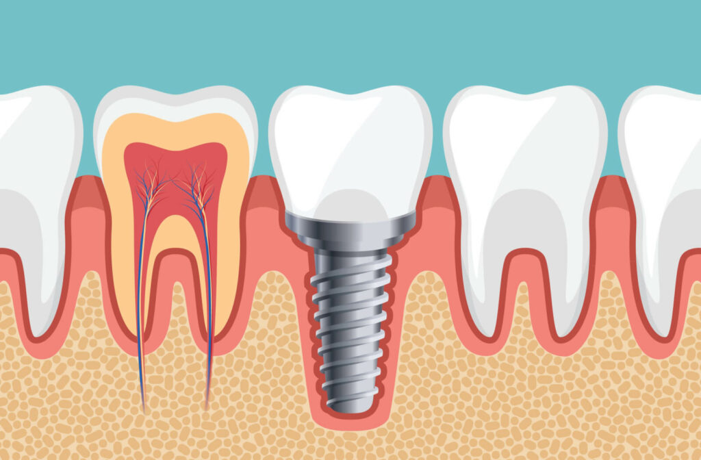 Animated-image-of-dental-implant-and-healthy-teeth.