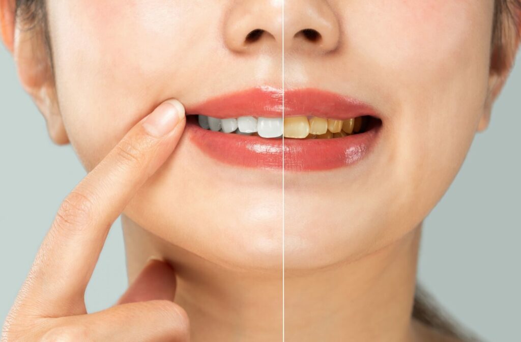 An image showing two halves of a woman's face, one with pearly white teeth, the other with clearly yellowed teeth.