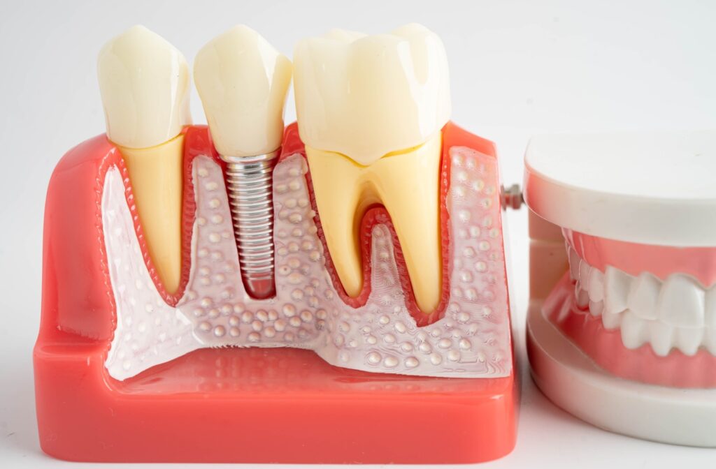 A model of a mouth displaying a dental implant with crown.