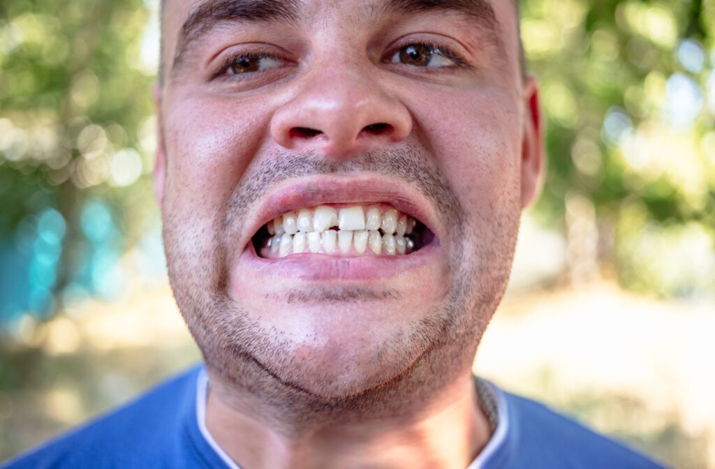 A close up on a person grinning while showcasing a chipped tooth