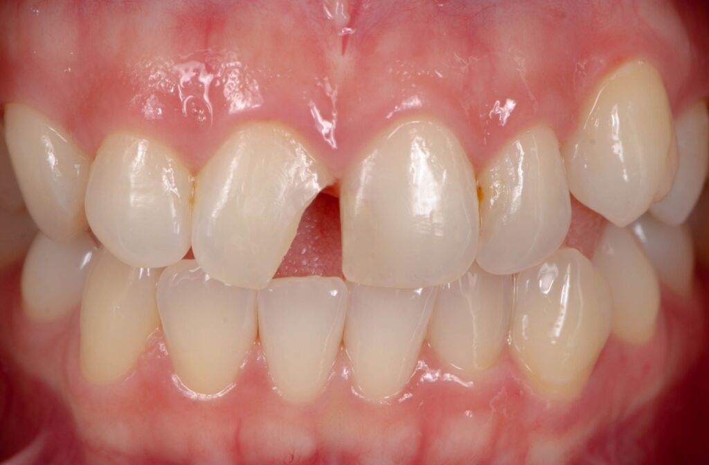 A close up of a set teeth with a chipped front tooth
