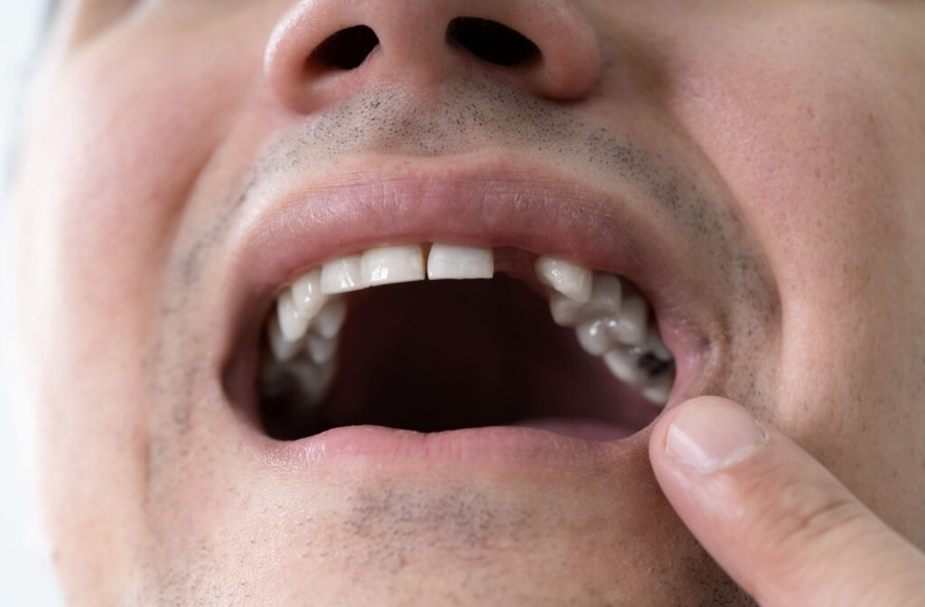 A person pointing to the missing tooth in their mouth