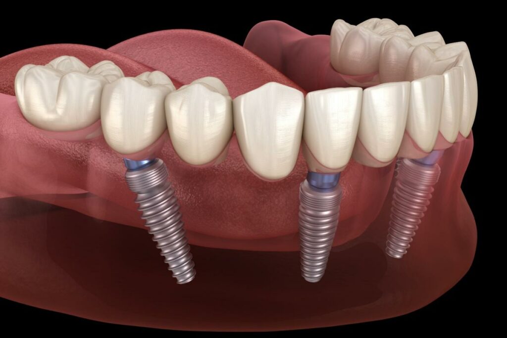 A 3D rendering of a mouth that shows what all-on-four dental implants looks like.